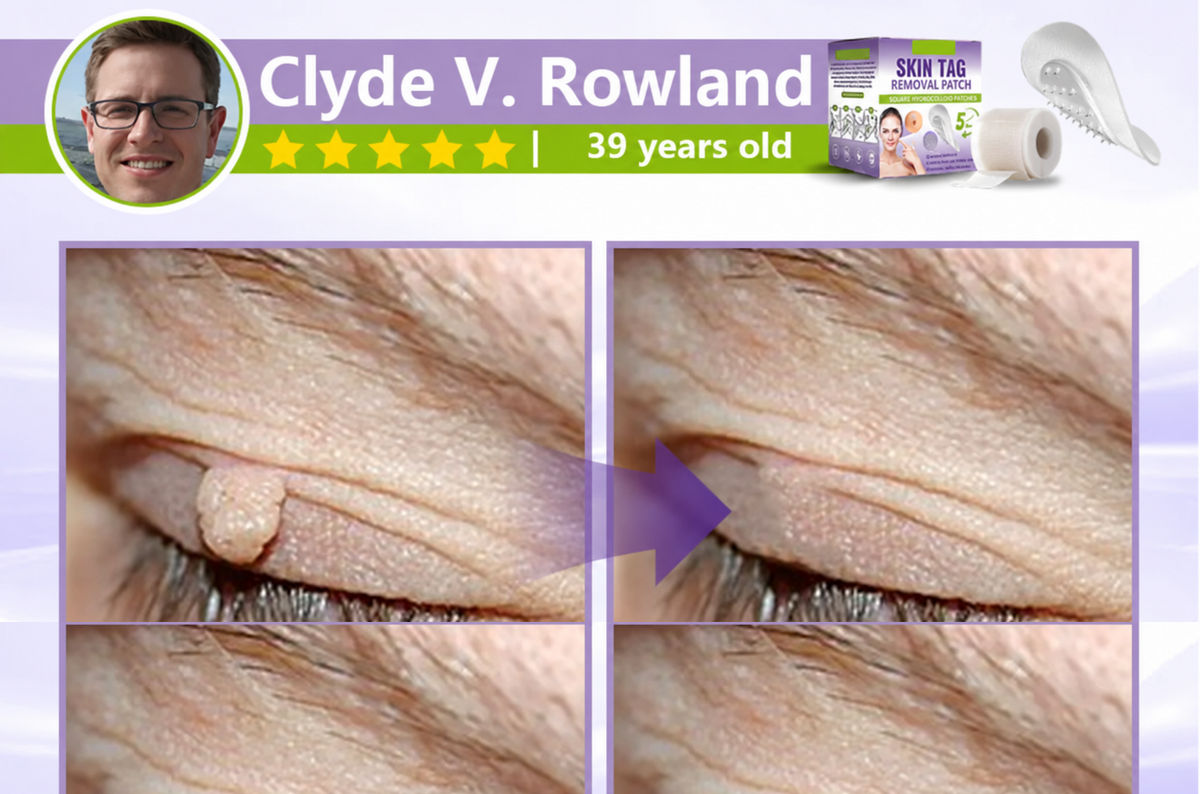 Soluble Microneedle Botanical Skin Tag Removal Patch