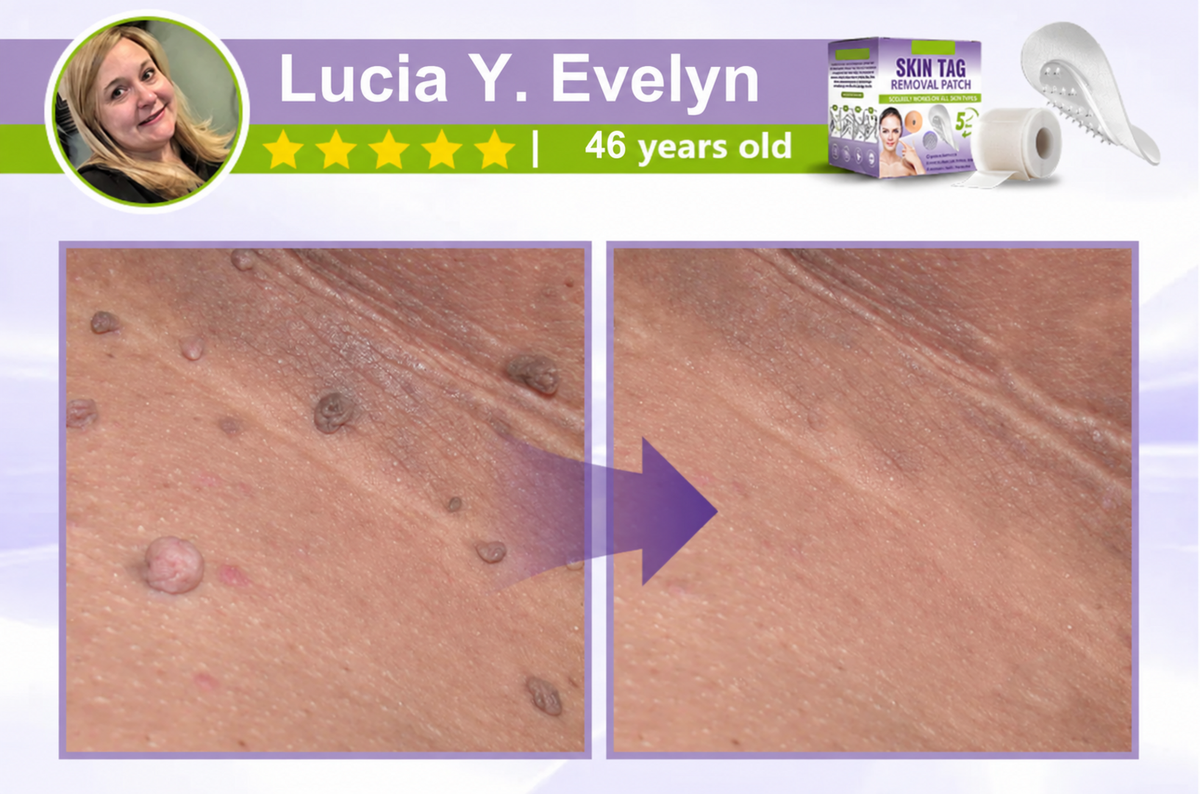 Soluble Microneedle Botanical Skin Tag Removal Patch